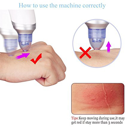 Blackhead remover4